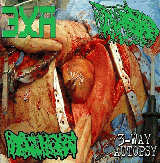 Hydrocephalus : 3-Way Autopsy Hydrocephalus : 3-Way Autopsy